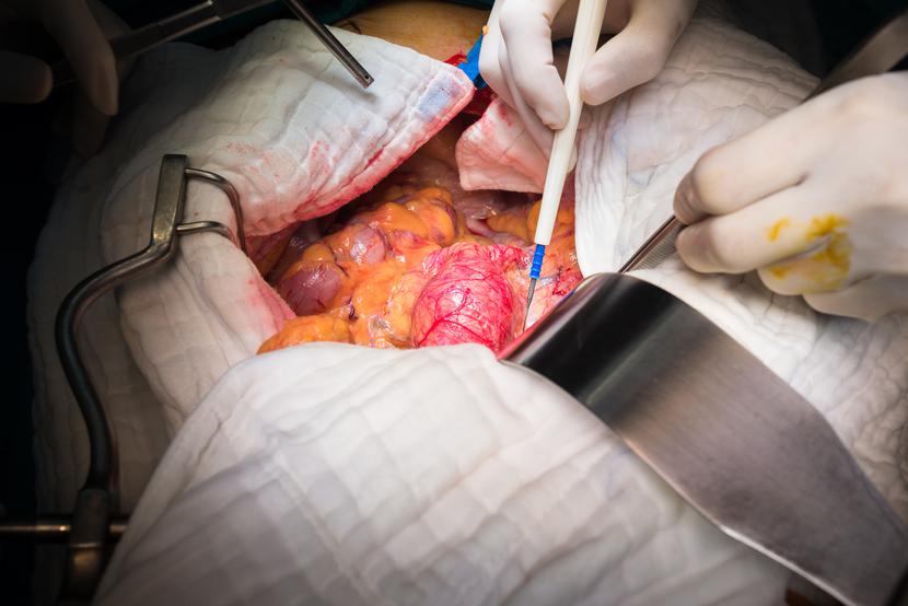 Operacja tętniaka aorty brzusznej
