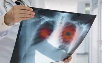 Leczenie chirurgiczne raka płuca - rozwój technik małoinwazyjnych