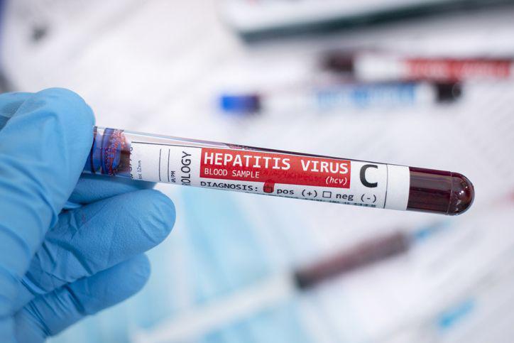 Wirus HCV jest wysoce zakaźny i może być przenoszony płciową - Puls Medycyny - pulsmedycyny.pl