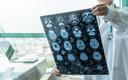 Nawracający uraz mózgu może zwiększać ryzyko choroby Alzheimera [BADANIE]
