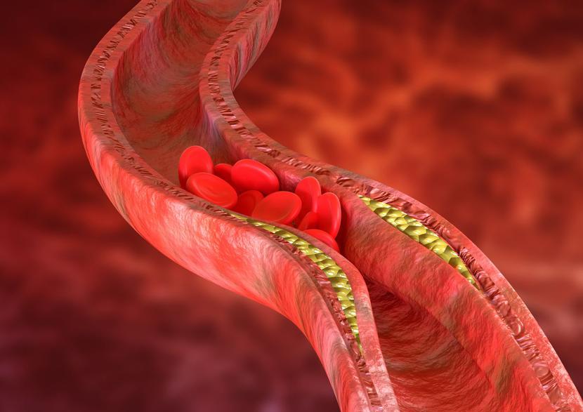 Hipercholesterolemia Rodzinna: Co Jeszcze Można Zrobić Dla Pacjentów?