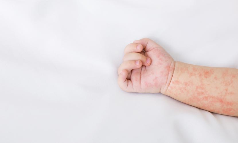 Z badań wynika, że u 12 proc. dzieci urodzonych przez cięcie cesarskie nie wystąpiła odpowiedź immunologiczna po pierwszym szczepieniu przeciwko odrze. Z badań wynika, że u 12 proc. dzieci urodzonych przez cięcie cesarskie nie wystąpiła odpowiedź immunologiczna po pierwszym szczepieniu przeciwko odrze.