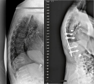 Mało inwazyjny zabieg przezskórnej stabilizacji kręgosłupa u 81-letniej pacjentki ze złamanym kręgiempiersiowym Th11 i zaawansowaną osteoporozą  - sylwetka pacjentki przed i po operacji.