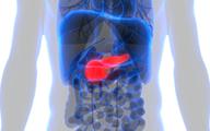 Rak trzustki: sztuczna inteligencja wspiera profilaktykę onkologiczną