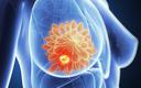 W jaki sposób chemioterapia raka piersi uszkadza naczynia krwionośne? Odkrycie polskich naukowców