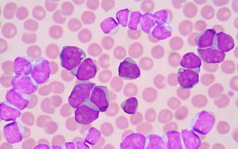 Ostra białaczka szpikowa: eksperci pozytywnie o nowej liście refundacyjnej