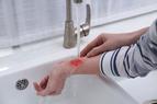 Rola farmaceuty w pierwszej pomocy przy oparzeniu