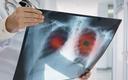 Rak płuca - badania przesiewowe u 18 tys. palaczy pomogą wykryć wczesne stadia choroby