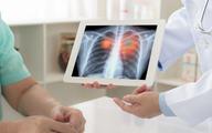 Rak płuca: jak zmniejszyć liczbę zachorowań i zwiększyć wskaźnik przeżyć 5-letnich?