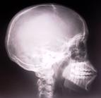 Inhibitory konwertazy angiotensyny a rozwój demencji