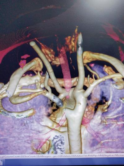 OBRAZ 3D pierścienia naczyniowego w postaci nieprawidłowo przebiegającej aorty