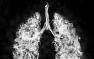 Rak płuca: lekarze POZ nie są zainteresowani programem profilaktyki palenia tytoniu