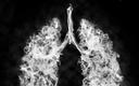 Rak płuca: lekarze POZ nie są zainteresowani programem profilaktyki palenia tytoniu