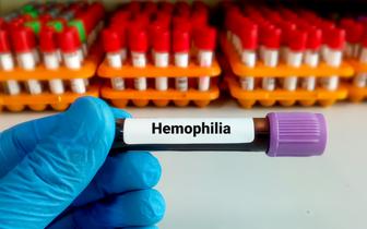NFZ wprowadza zmiany w leczeniu hemofilii i pokrewnych skaz krwotocznych