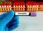 NFZ wprowadza zmiany w leczeniu hemofilii i pokrewnych skaz krwotocznych