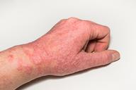 Atopowe zapalenie skóry: jak można je nowocześnie leczyć?