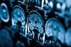 Ekspozycja na światło i dźwięk może spowolnić chorobę Alzheimera? Są badania