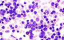 Eksperci: nowa terapia na przewlekłą białaczkę limfocytową wyjątkowo skuteczna