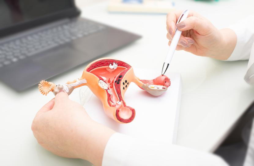 Mamy niepokojącą sytuację w raku endometrium. Odnotowujemy nie tylko wzrost zachorowań, ale też umieralności. Mamy niepokojącą sytuację w raku endometrium. Odnotowujemy nie tylko wzrost zachorowań, ale też umieralności.