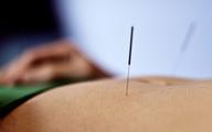 Akupunkturą nie wyleczysz niepłodności