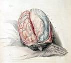 Głęboka stymulacja mózgu w leczeniu zaburzeń pamięci