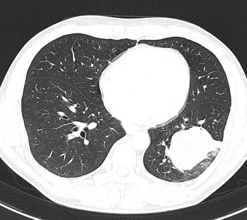 Przerzut w płucu przed rozpoczęciem leczenia enkorafenibem i binimetynibem.