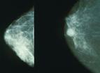 Ruszył krakowski Breast Unit