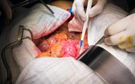 Po przechorowaniu COVID-19 tętniaki aorty brzusznej mogą szybciej rosnąć  [BADANIA]