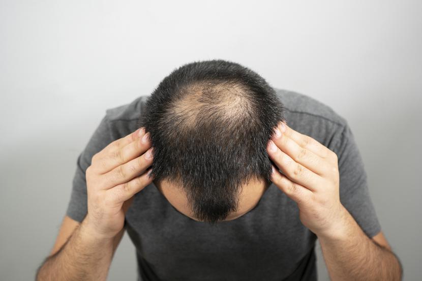 Wśród kilkudziesięciu objawów powikłań po COVID-19 pojawia się spadek sprawności seksualnej i utrata włosów.