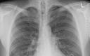 Co poprawić w diagnostyce i terapii raka płuca
