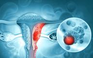 Rak jajnika - gen kodujący białko XPR1 słabym punktem nowotworu [BADANIA]