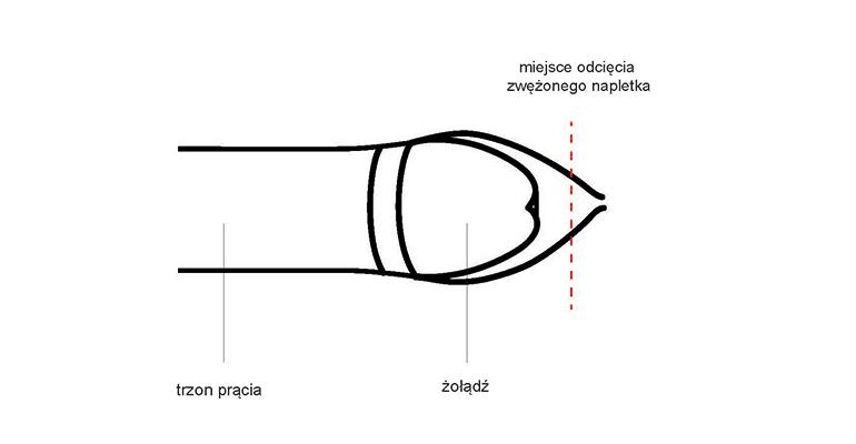 Plastyka napletka polega na odcięciu zwężonej części napletka i ponownym zeszyciu obu jego blaszek tak, aby napletek pokrywał żołądź i był na tyle szeroki, by był bez problemu zsuwalny do rowka zażołędnego. 