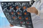 U pacjentów z udarem mózgu COVID-19 niemal trzykrotnie zwiększa ryzyko zgonu [BADANIE]