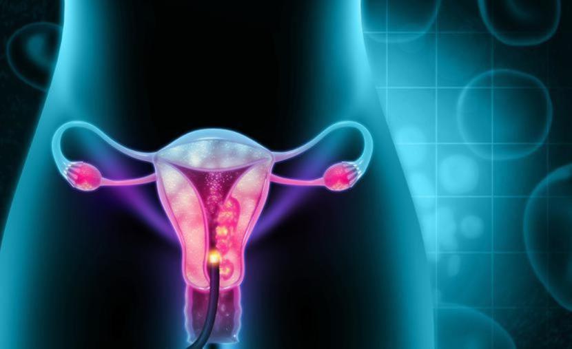 Na endometriozę cierpi około 10 proc. kobiet. Nadal nie jest jasne, co dokładnie powoduje ten stan. Na endometriozę cierpi około 10 proc. kobiet. Nadal nie jest jasne, co dokładnie powoduje ten stan.