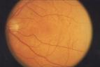 Nowe narzędzie do badania retinopatii cukrzycowej