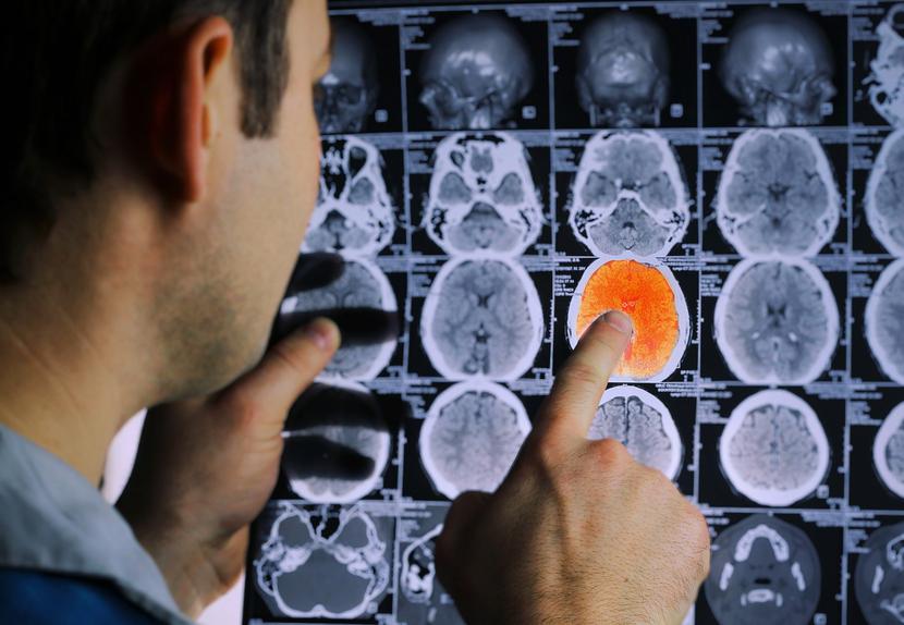 Nowy typ urządzenia do leczenia tętniaków mózgu w Uniwersyteckim Szpitalu Klinicznym. Nowy typ urządzenia do leczenia tętniaków mózgu w Uniwersyteckim Szpitalu Klinicznym.