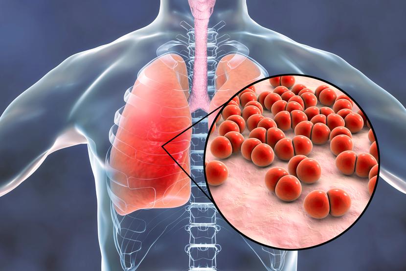 Zakażenie wywołane przez bakterie Streptococcus pneumoniae może prowadzić do ciężkiego zapalenia płuc, sepsy. Zakażenie wywołane przez bakterie Streptococcus pneumoniae może prowadzić do ciężkiego zapalenia płuc, sepsy.