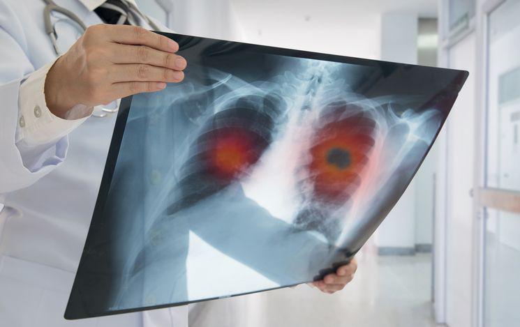 Obecnie w wielu sytuacjach pacjenci żyją 3-5 lat z uogólnionym rakiem płuca.