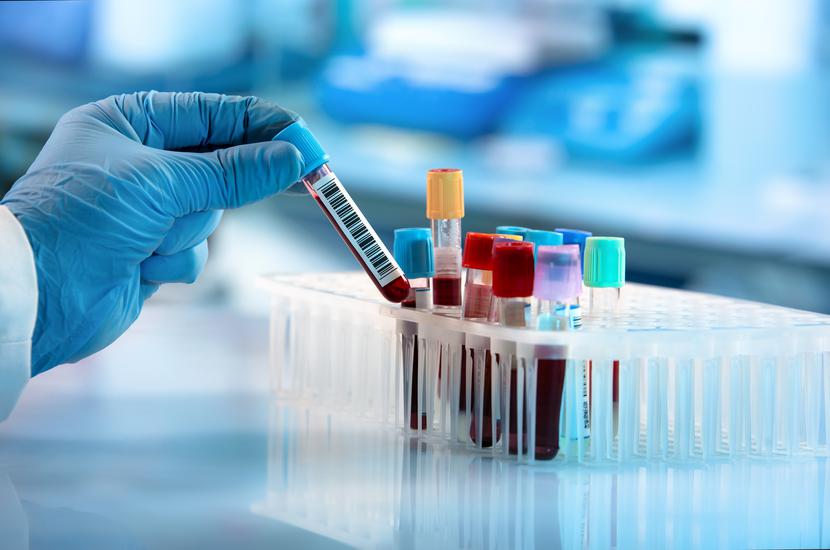 Badania wykazały, że test PSA jest niedokładny - zwiększa wykrywalność nowotworów prostaty niskiego ryzyka i pomija niektóre nowotwory wysokiego ryzyka. Badania wykazały, że test PSA jest niedokładny - zwiększa wykrywalność nowotworów prostaty niskiego ryzyka i pomija niektóre nowotwory wysokiego ryzyka.