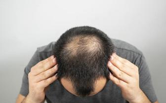 Lekarz trycholog ostrzega przed przeszczepami włosów w tańszych krajach [WYWIAD]