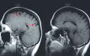 Migrena wymaga innego podejścia terapeutycznego niż zwykły ból głowy