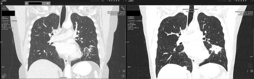 Fot. 4 - regresja zmian przerzutowych w płucach oraz węzłach chłonnych po obu stronach przepony.