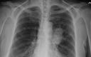 Pacjenci z nowotworem płuca nadal czekają na leki