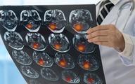 Udary po COVID-19. Neurolog: najmłodszy pacjent miał kilkanaście miesięcy