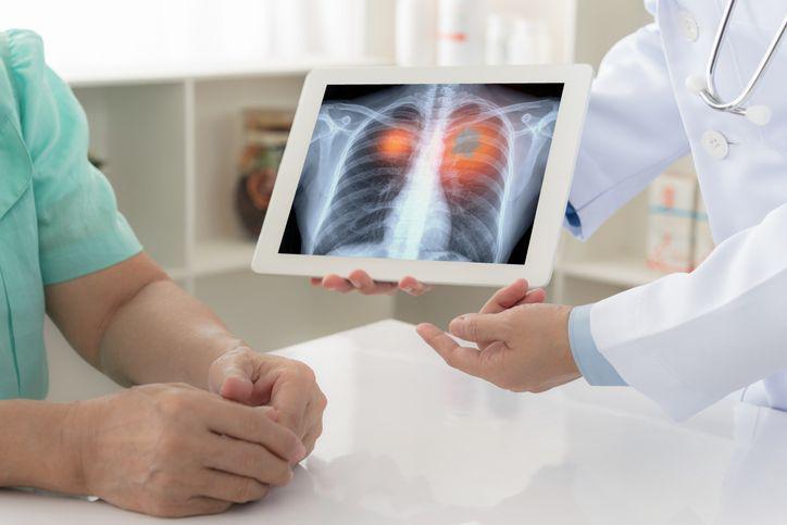 W leczeniu operacyjnym raka płuca preferowane są techniki małoinwazyjne, ponieważ znacząco zmniejszają one zarówno ryzyko śmiertelności, jak i liczbę powikłań pooperacyjnych.