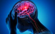 Potwierdzono, że statyny obniżają ryzyko krwotocznego udaru mózgu [BADANIE]