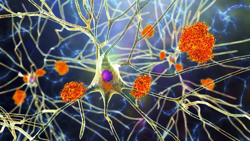 Neurony w chorobie Alzheimera. Ilustracja przedstawiająca blaszki amyloidu w tkance mózgowej