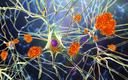 Zarzut sfabrykowania badań podważa kluczową teorię na temat choroby Alzheimera