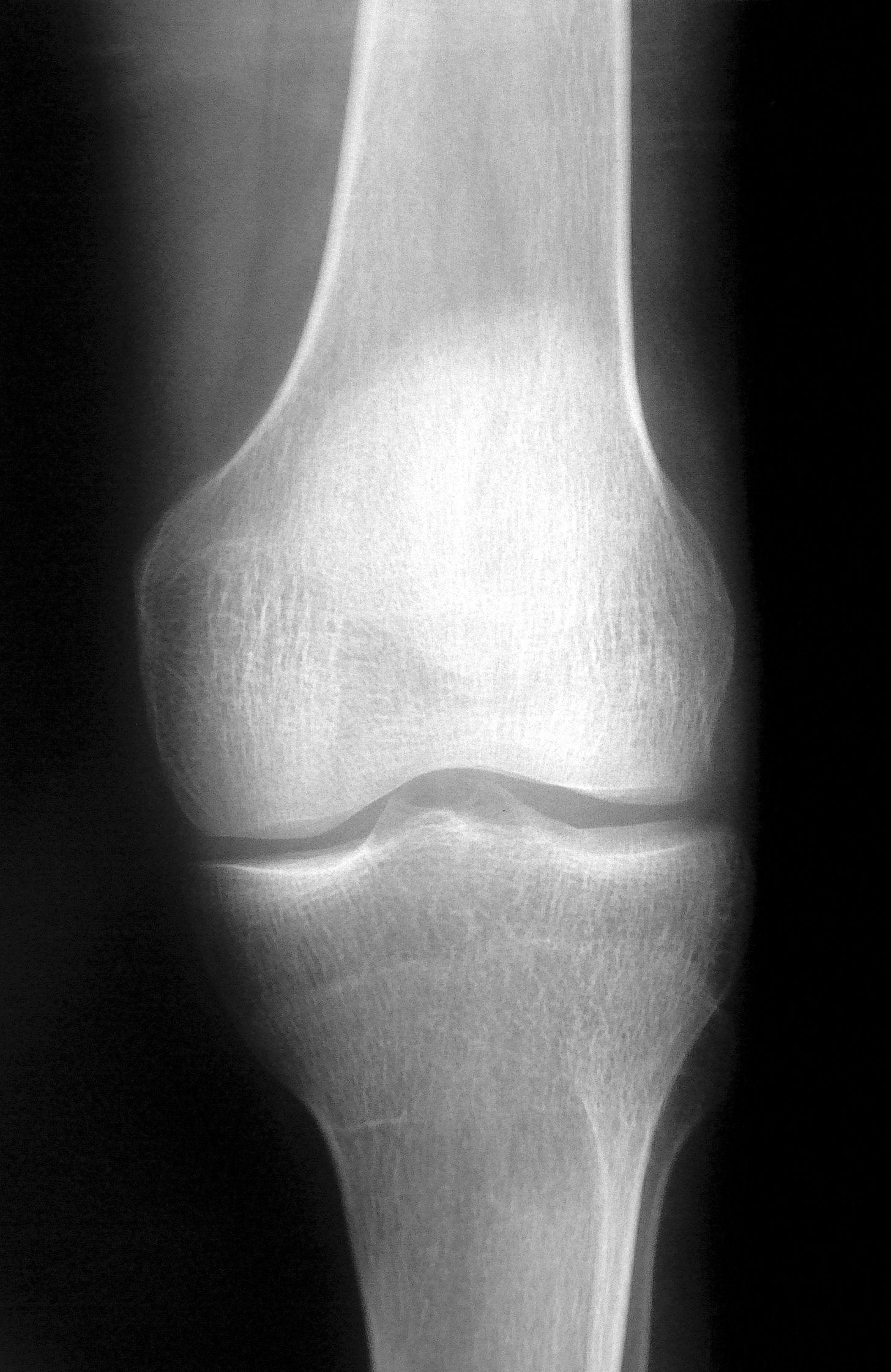 Рентген колена. Бурсит коленного сустава рентген. Синовит коленного сустава рентген снимки. Рентген здорового коленного сустава. Синовит коленного сустава рентген.