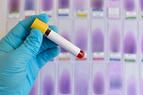 Badanie krwi (płynna biopsja) pomoże wykryć raka płuca